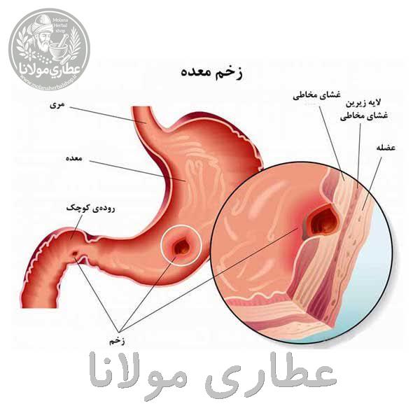  زخم معده ۱